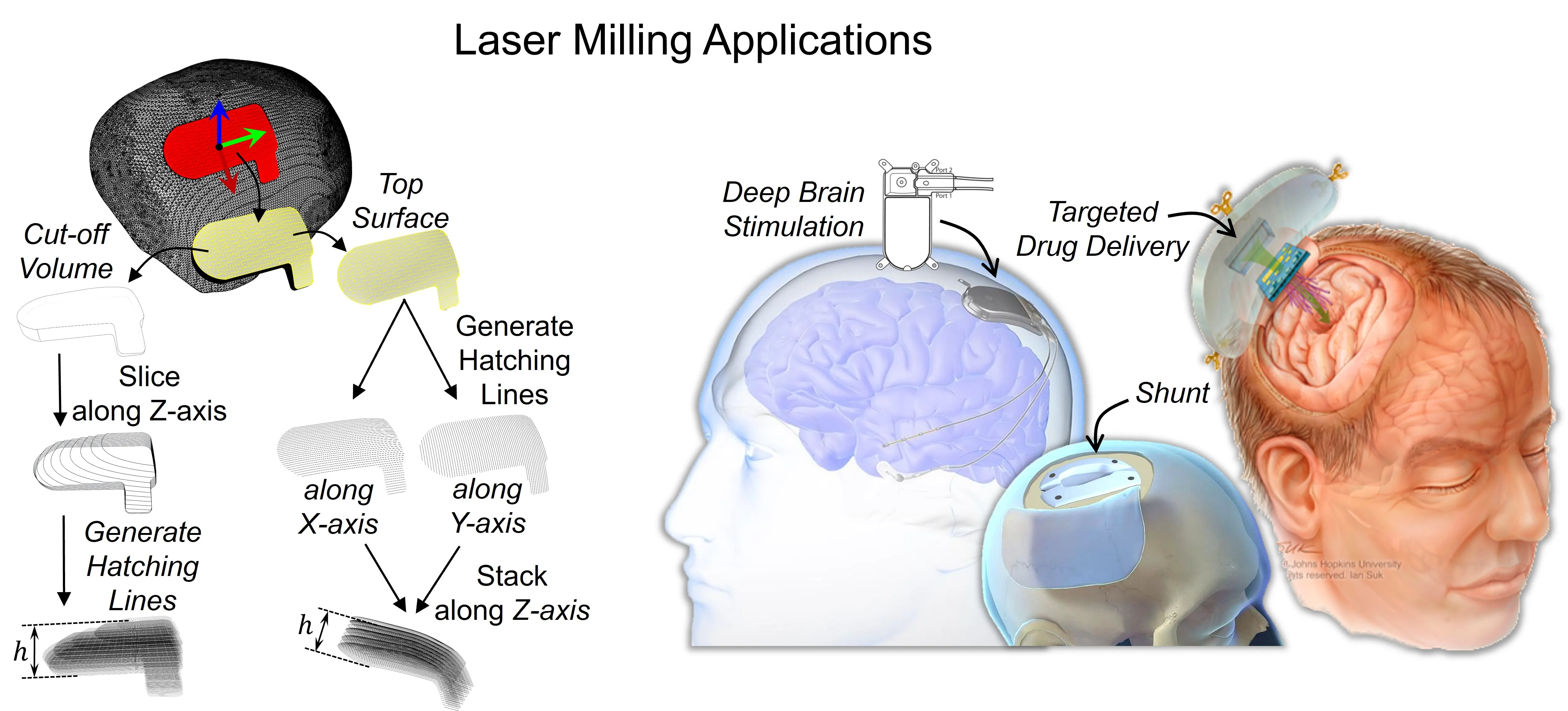 5-Axis Laser Cutting System for Cranial Implants Modification