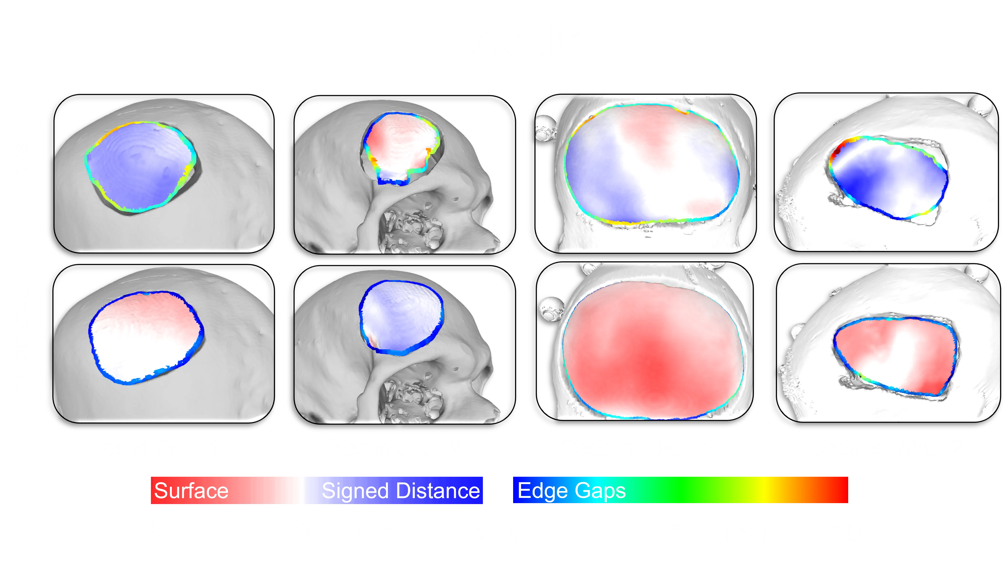 Automated Implant Modification in Neuroplastic Surgery