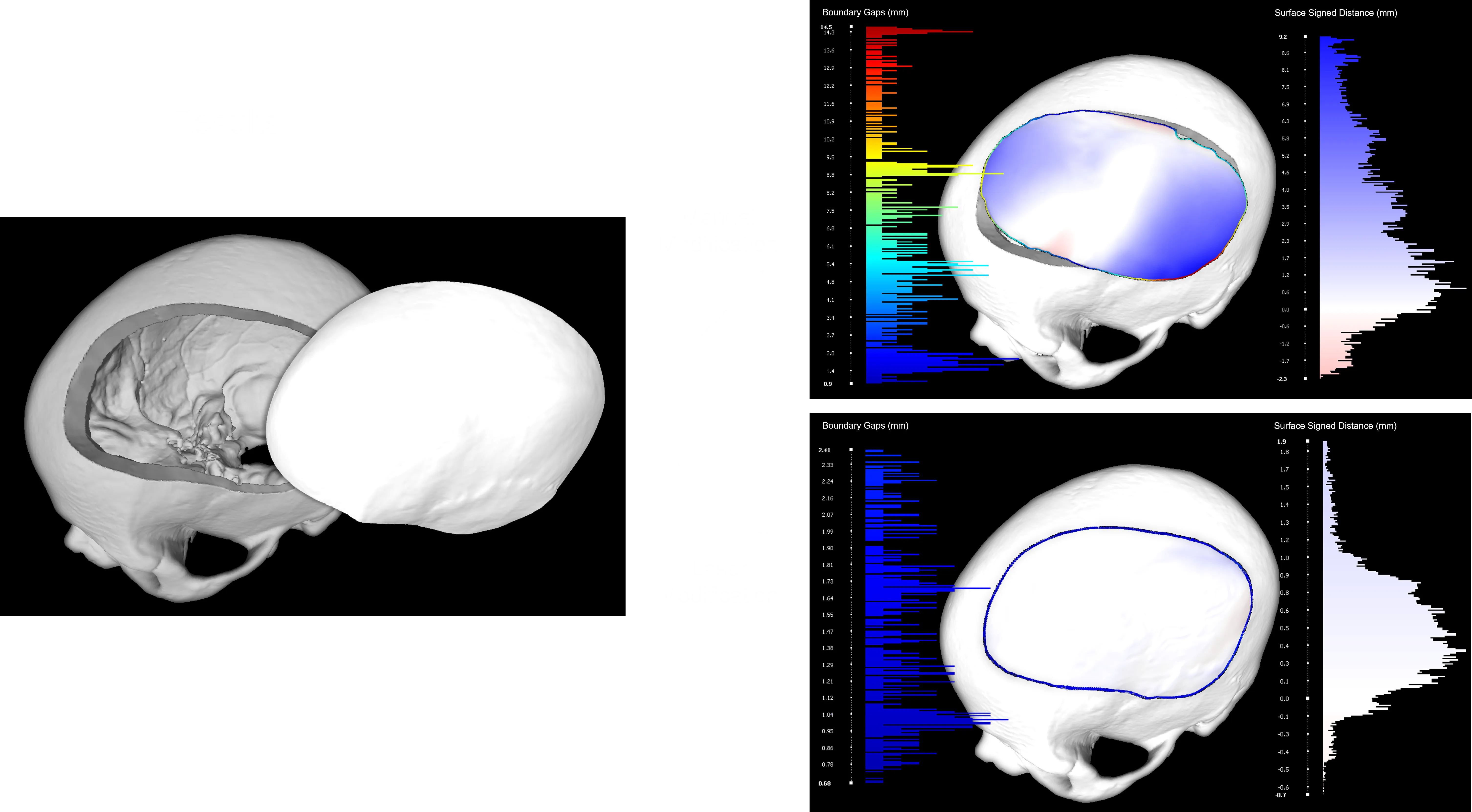 5-Axis Laser Cutting System for Cranial Implants Modification